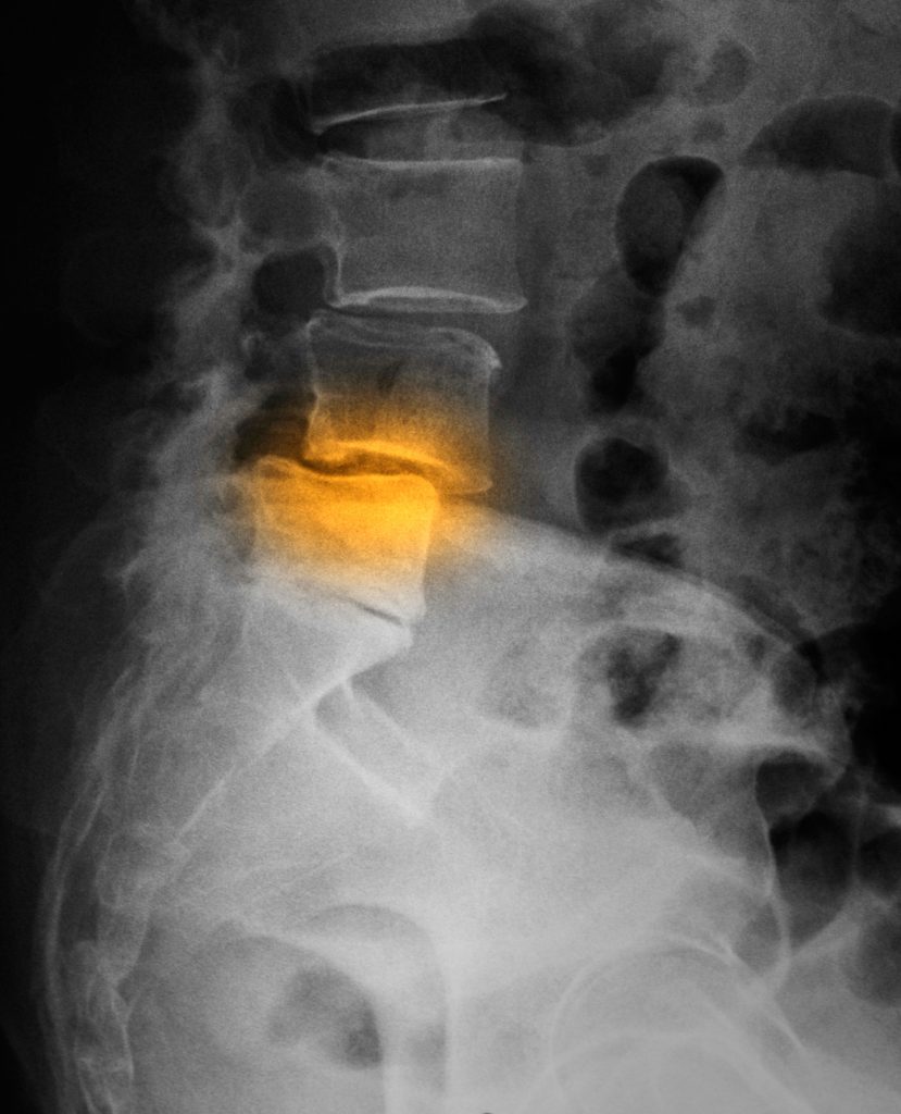 spondylolisthesis 