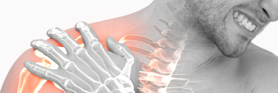 Subacromial impingement